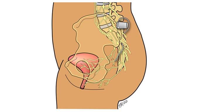 Urinary incontinence